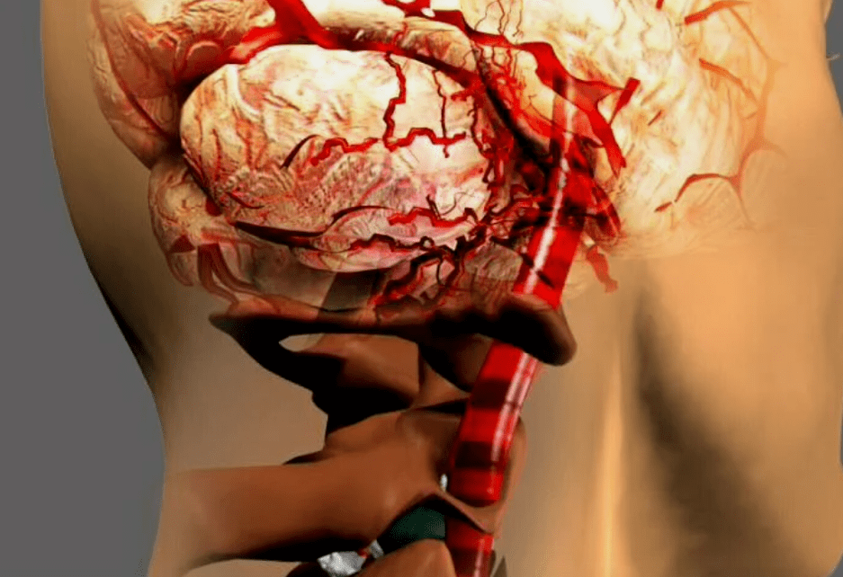 Cette ostéochondose cervicale est dangereuse