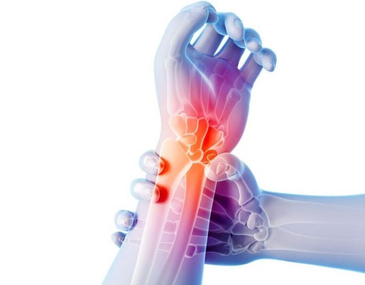 L'arthrose des articulations s'accompagne de douleurs et nécessite un traitement complexe.
